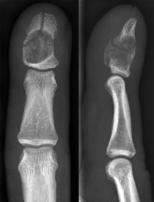 Radiograph from the case bank: Enchondroma