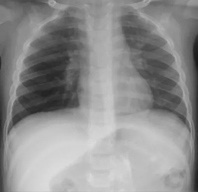 Radiograph from the case bank: Inhaled (aspirated) foreign body