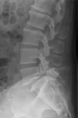 Radiograph from the case bank: Spondylolisthesis