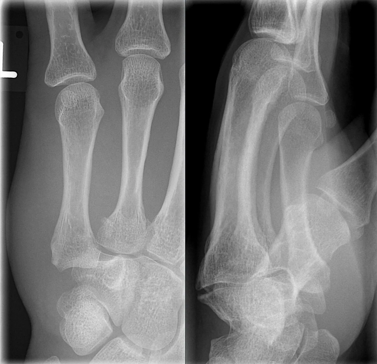 Upper limb radiograph for self-assessment