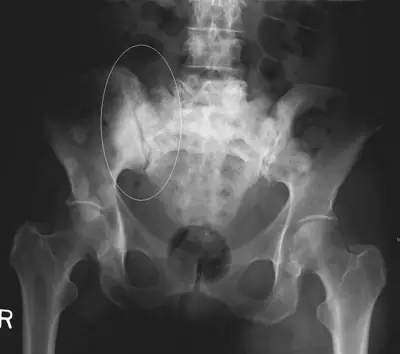 Radiograph from the case bank: Bone metastases