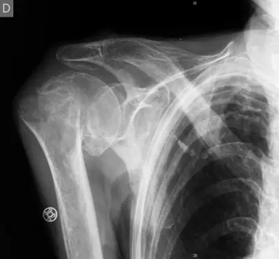 Radiograph from the case bank: Proximal humerus fracture