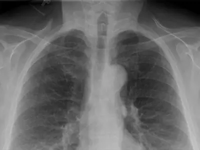 Radiograph from the case bank: Central venous catheter
