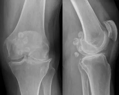 Radiograph from the case bank: Synovial chondromatosis