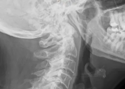 Radiograph from the case bank: Degenerative spondylosis