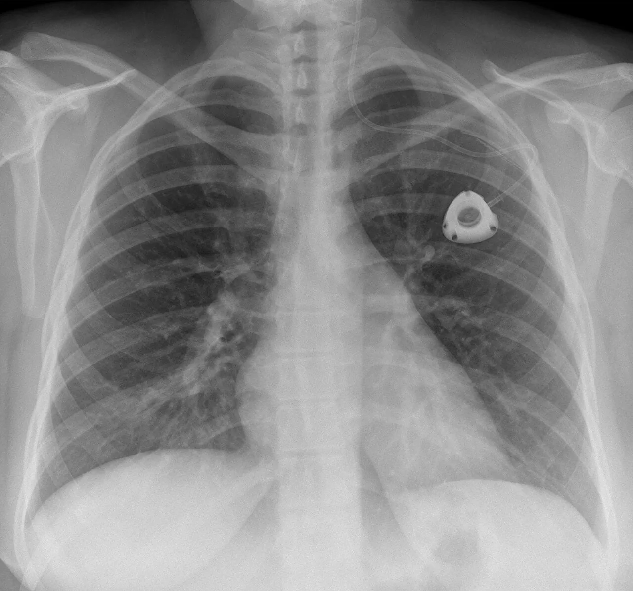 Lines & tubes radiograph for self-assessment