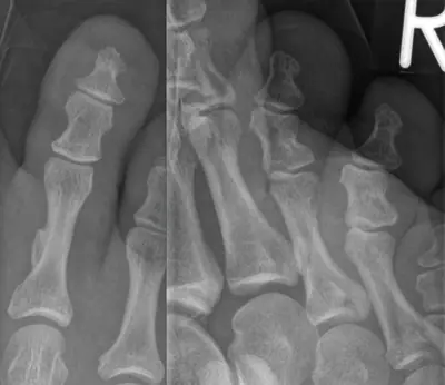 Radiograph from the case bank: Osteochondroma (exostosis)