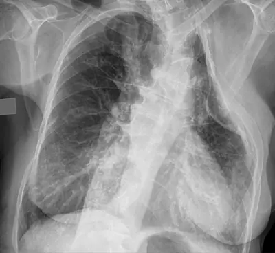 Radiograph from the case bank: Pulmonary tuberculosis