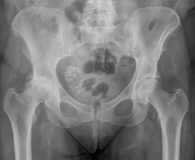 Radiograph from the case bank: Calcified uterine fibroid