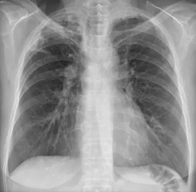 Radiograph from the case bank: Pulmonary tuberculosis