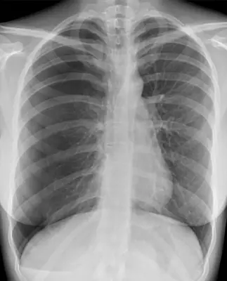Radiograph from the case bank: Pneumothorax