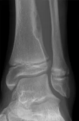 Radiograph from the case bank: Non-ossifying fibroma