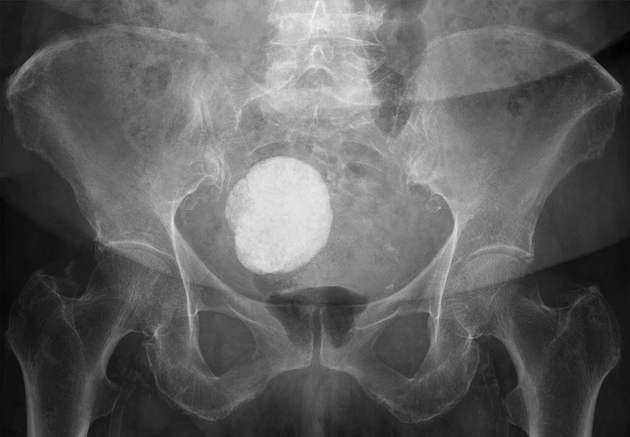 Abdomen radiograph for self-assessment