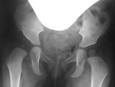 Radiograph from the case bank: Developmental dysplasia of the hip (DDH)