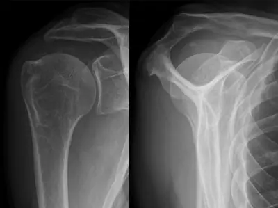 Radiograph from the case bank: Calcific tendinitis