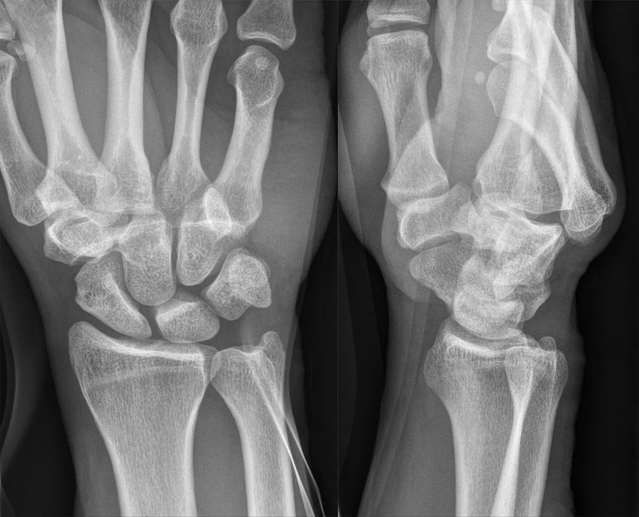 Upper limb radiograph for self-assessment