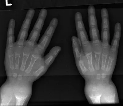 Radiograph from the case bank: Rickets
