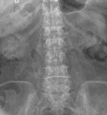 Radiograph from the case bank: Lumbar vertebral fracture