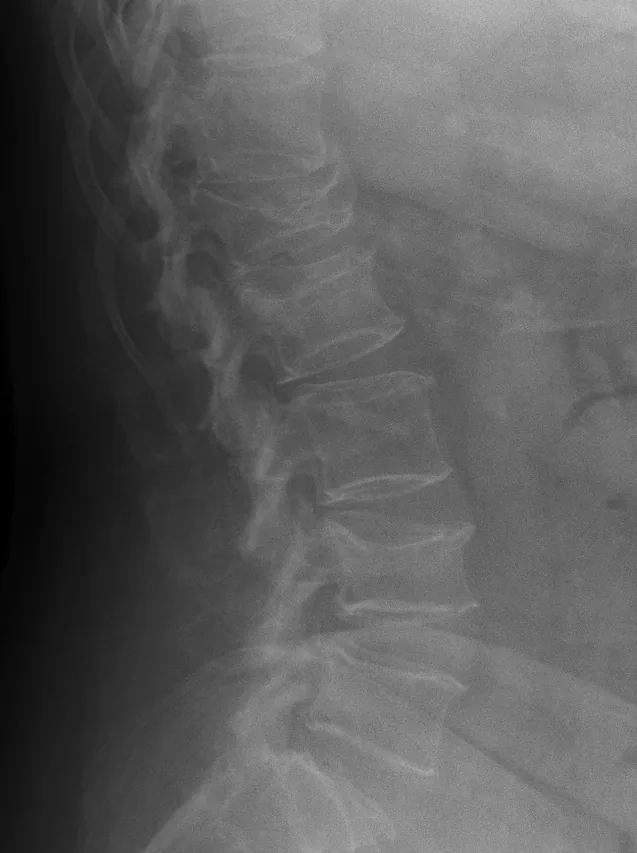 Spine radiograph for self-assessment