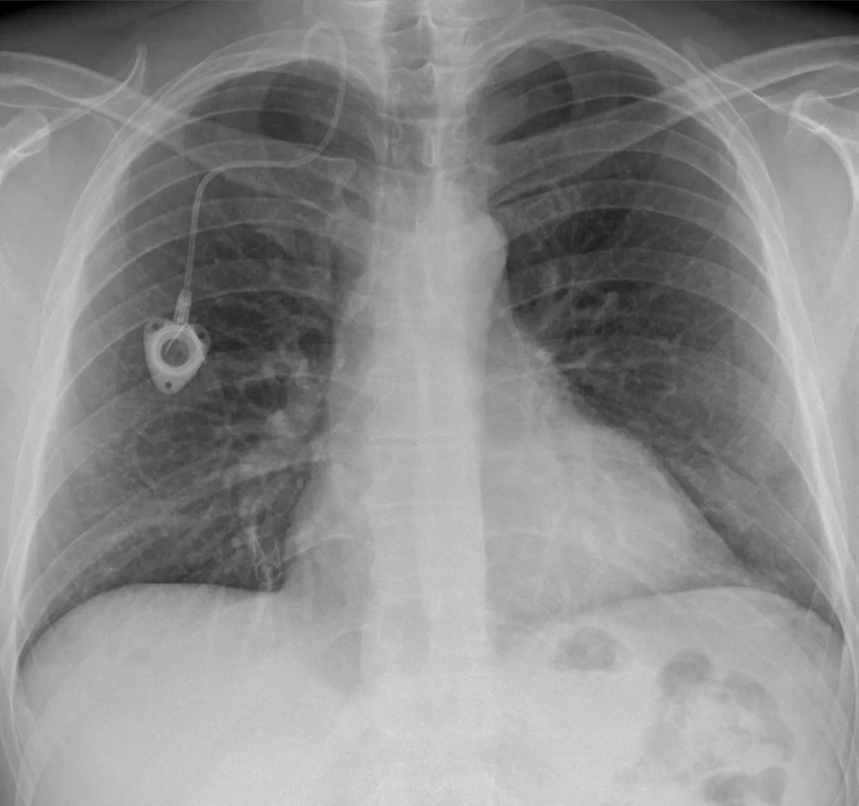 Lines & tubes radiograph for self-assessment