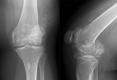 Radiograph from the case bank: Synovial chondromatosis