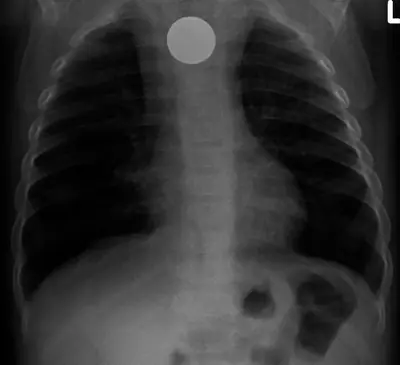 Radiograph from the case bank: Foreign body in the oesophagus