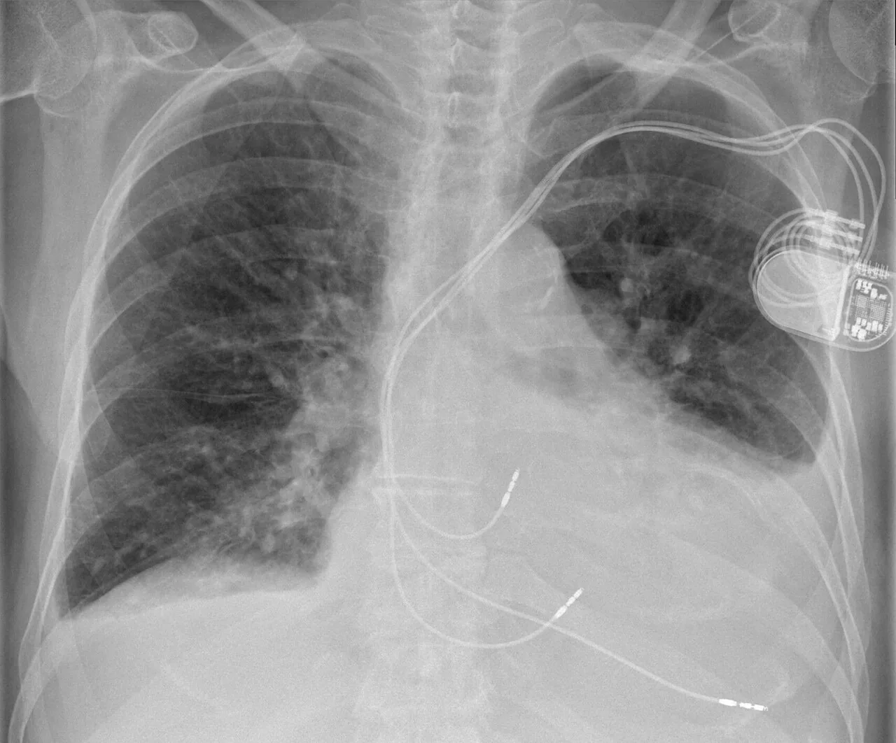 Lines & tubes radiograph for self-assessment