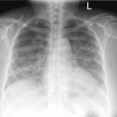 Chest radiograph for self-assessment
