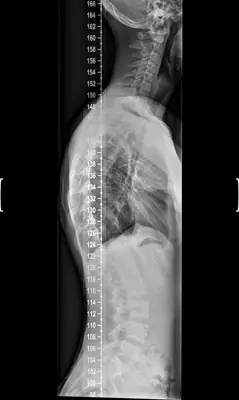 Radiograph from the case bank: Scoliosis