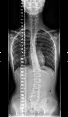 Radiograph from the case bank: Scoliosis