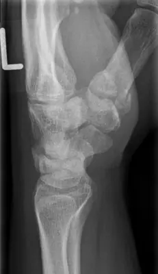 Radiograph from the case bank: Rolando fracture