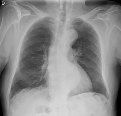 Radiograph from the case bank: Thoracic aortic aneurysm