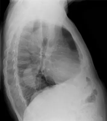 Radiograph from the case bank: Thoracic aortic aneurysm