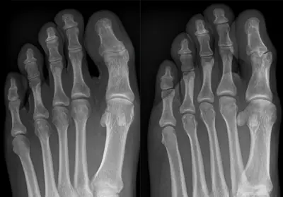 Radiograph from the case bank: Osteoma