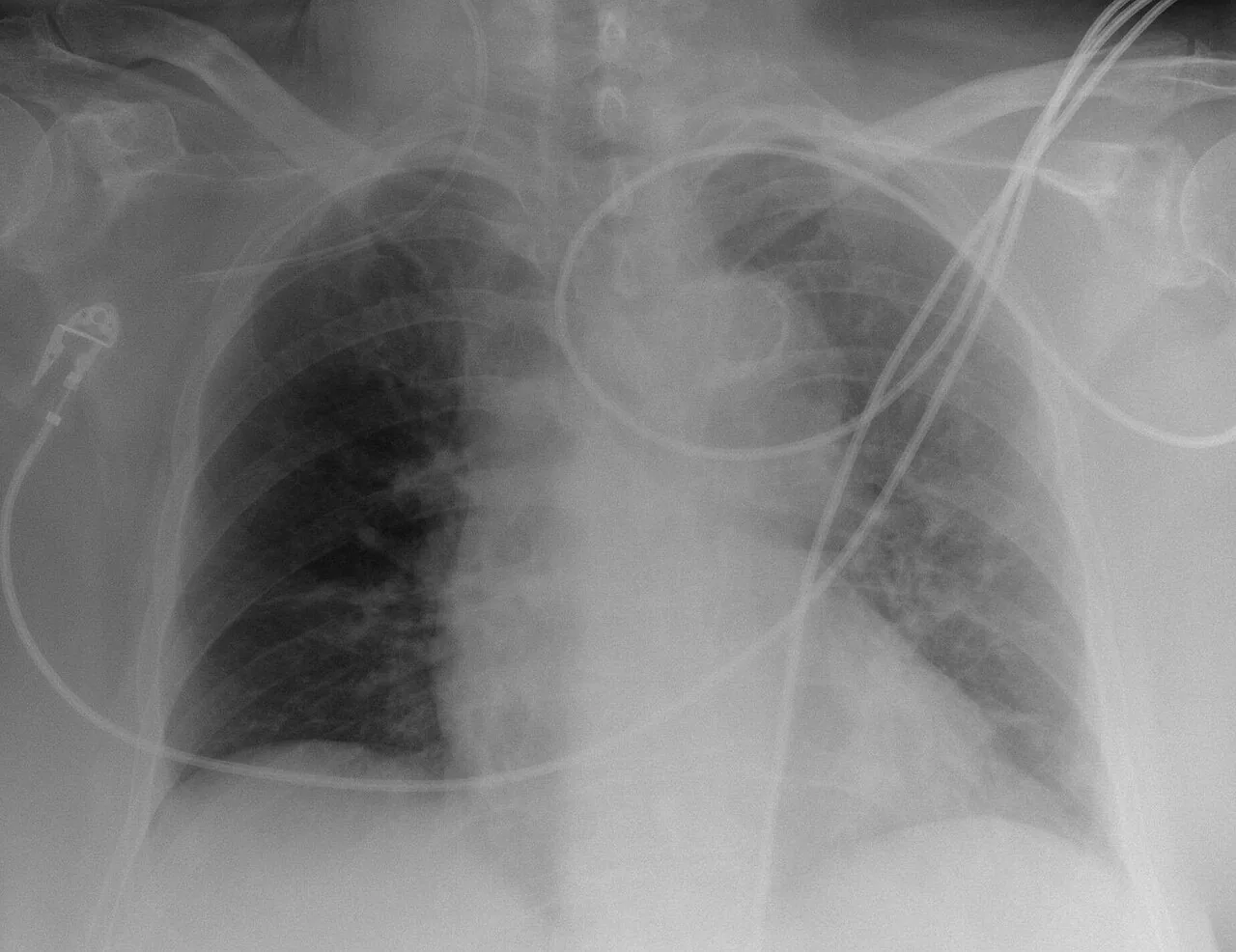 Lines & tubes radiograph for self-assessment