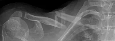 Radiograph from the case bank: Clavicle fracture