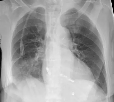 Radiograph from the case bank: Cardiac pacemaker