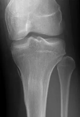 Radiograph from the case bank: Pellegrini–Stieda lesion
