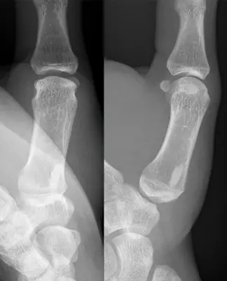 Radiograph from the case bank: Osteoma