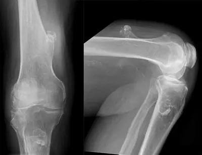 Radiograph from the case bank: Osteochondroma (exostosis)