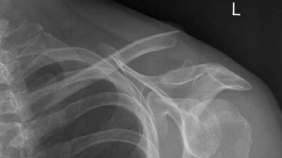 Upper limb radiograph for self-assessment