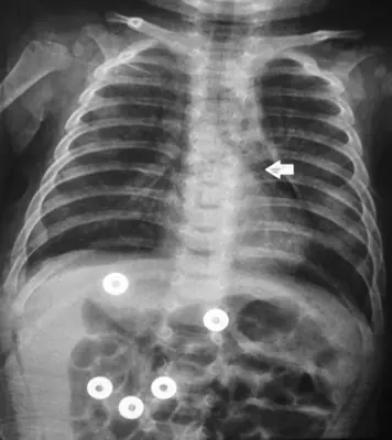 Radiograph from the case bank: Pneumomediastinum