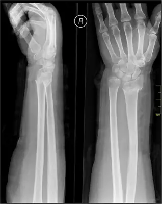 Radiograph from the case bank: Forearm shaft fracture (radius and ulna)