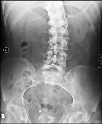 Radiograph from the case bank: Scoliosis