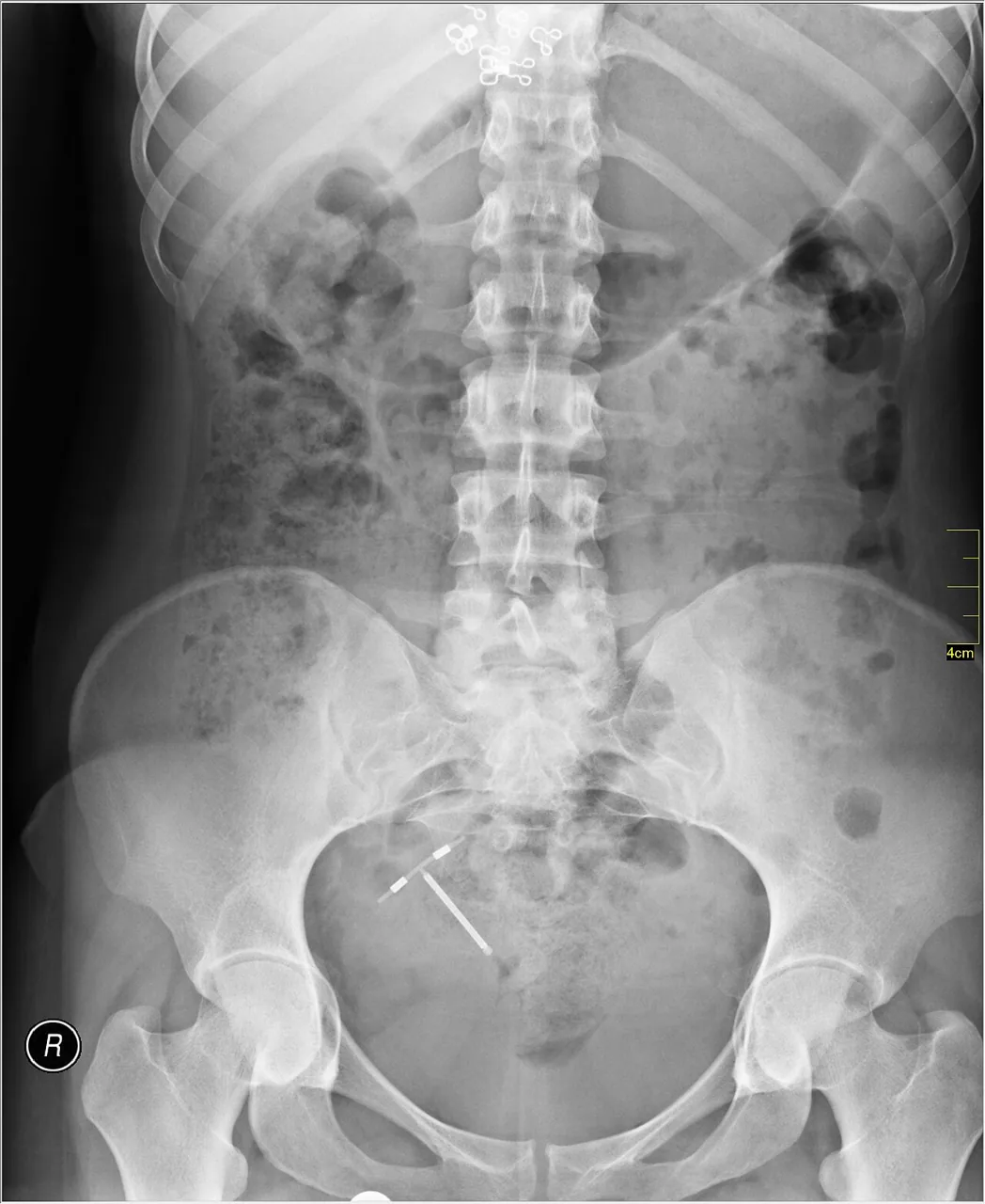 Abdomen radiograph for self-assessment