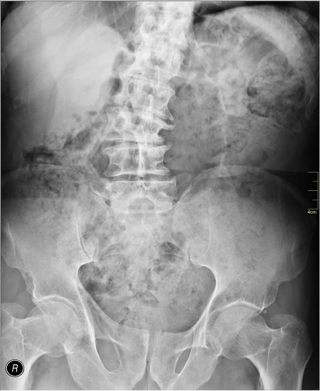 Spine radiograph for self-assessment