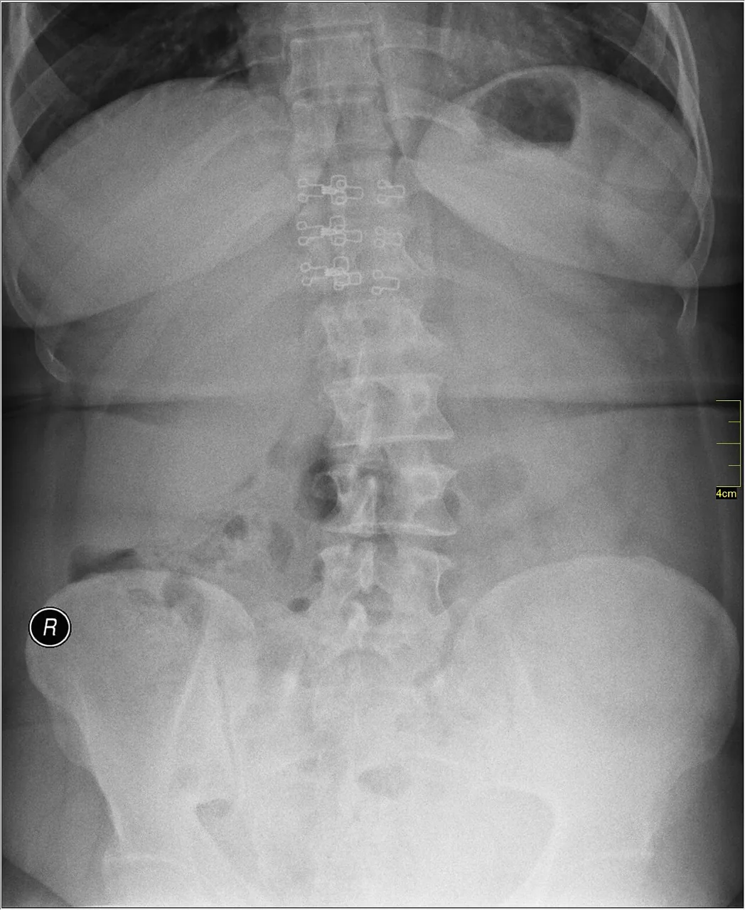 Spine radiograph for self-assessment