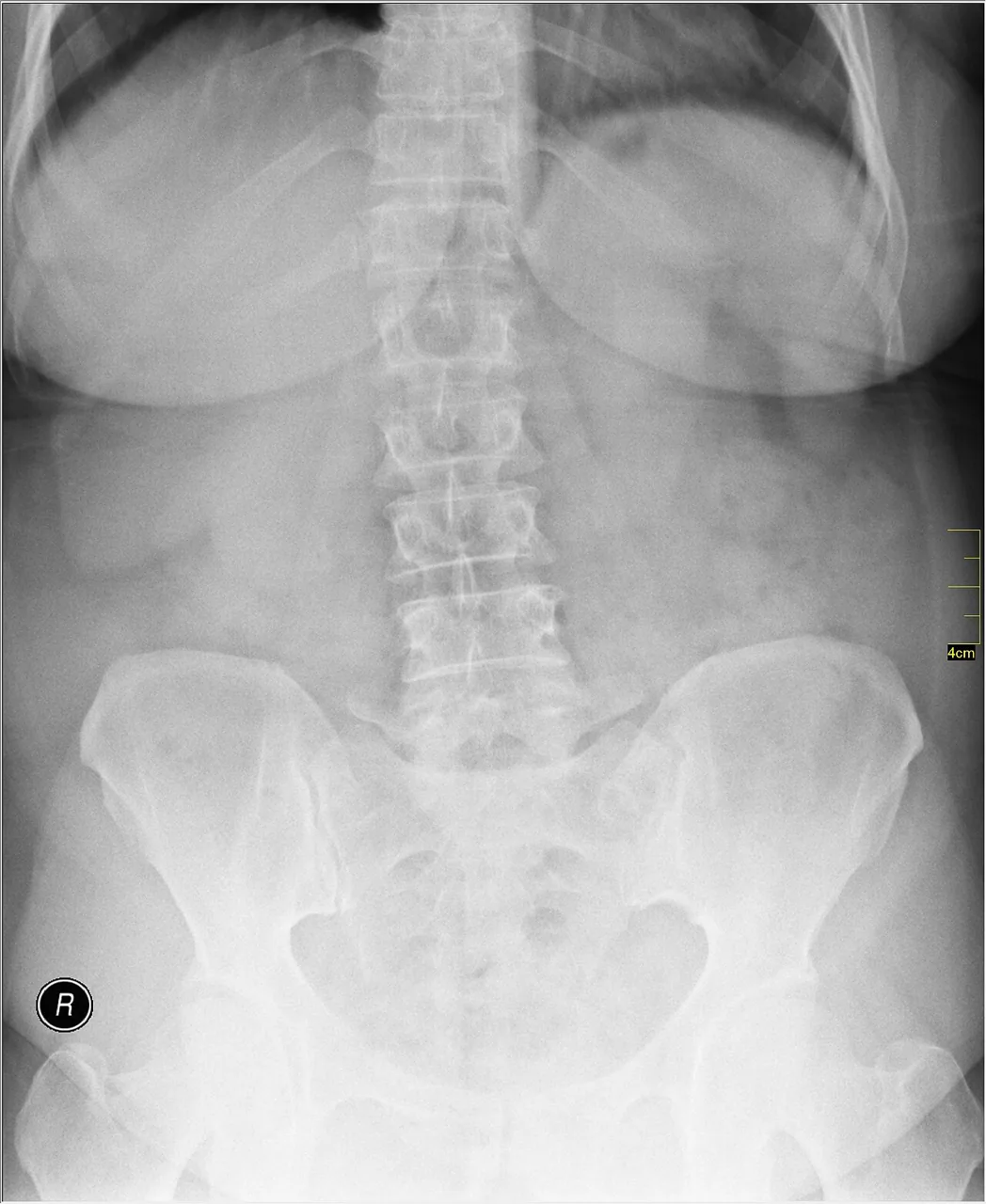 Spine radiograph for self-assessment