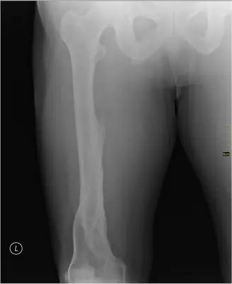 Radiograph from the case bank: Femoral shaft fracture