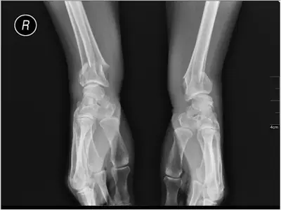 Radiograph from the case bank: Distal radius fracture